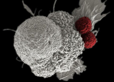A cancer cell being attacked